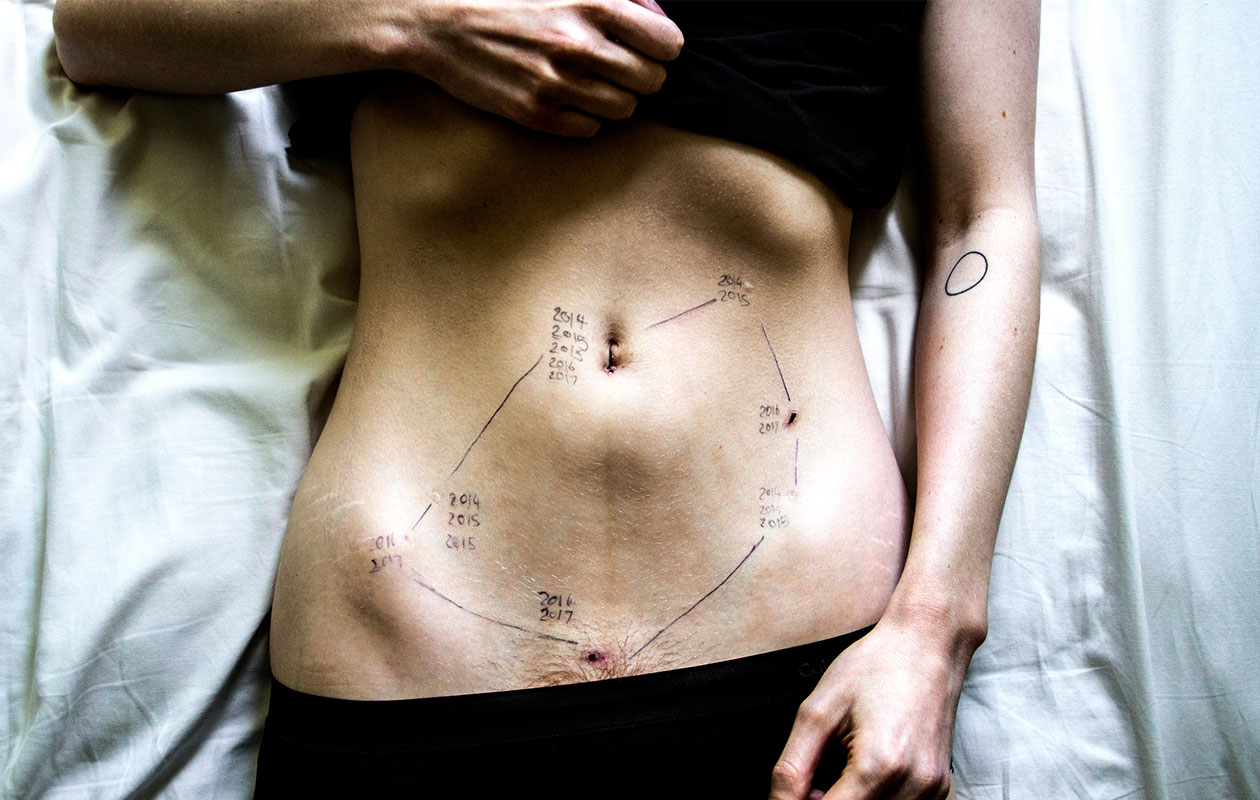 Så ser endometrios ut – drabbade delar bilder för att sprida kunskap