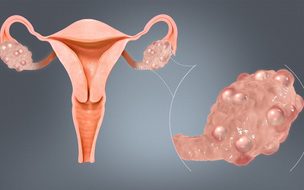 pcos symptom, kost och behandling
