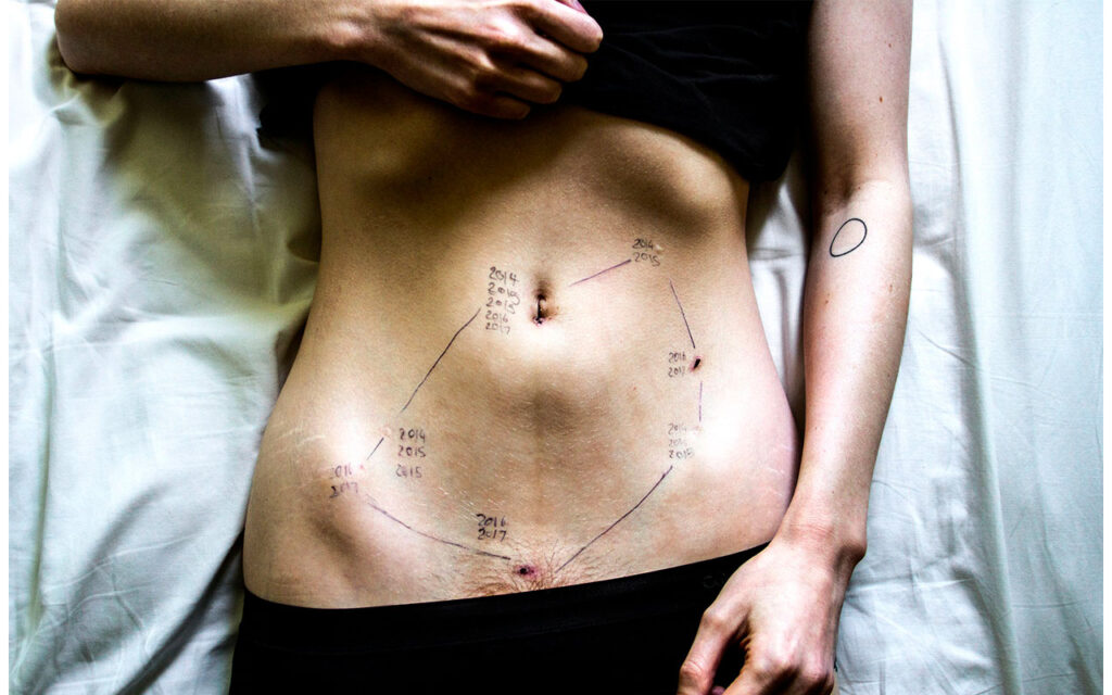 Endometriosärr efter en operation.