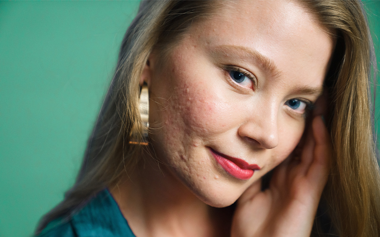 Yoella: “Min akne fick mig att våga vara mig själv”
